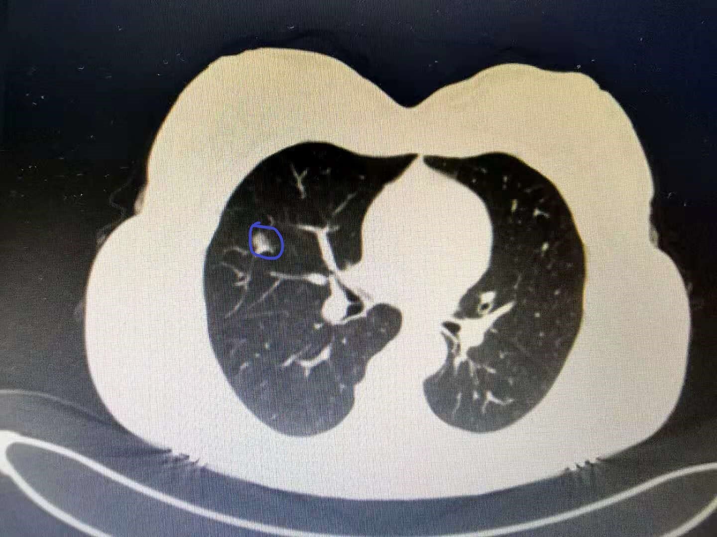 5厘米肿块,边界不清,血肿瘤标志物升高,高度怀疑肺癌.