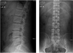 图1.正常腰椎x光片:腰椎骨结构和椎间隙相间隔.图2.