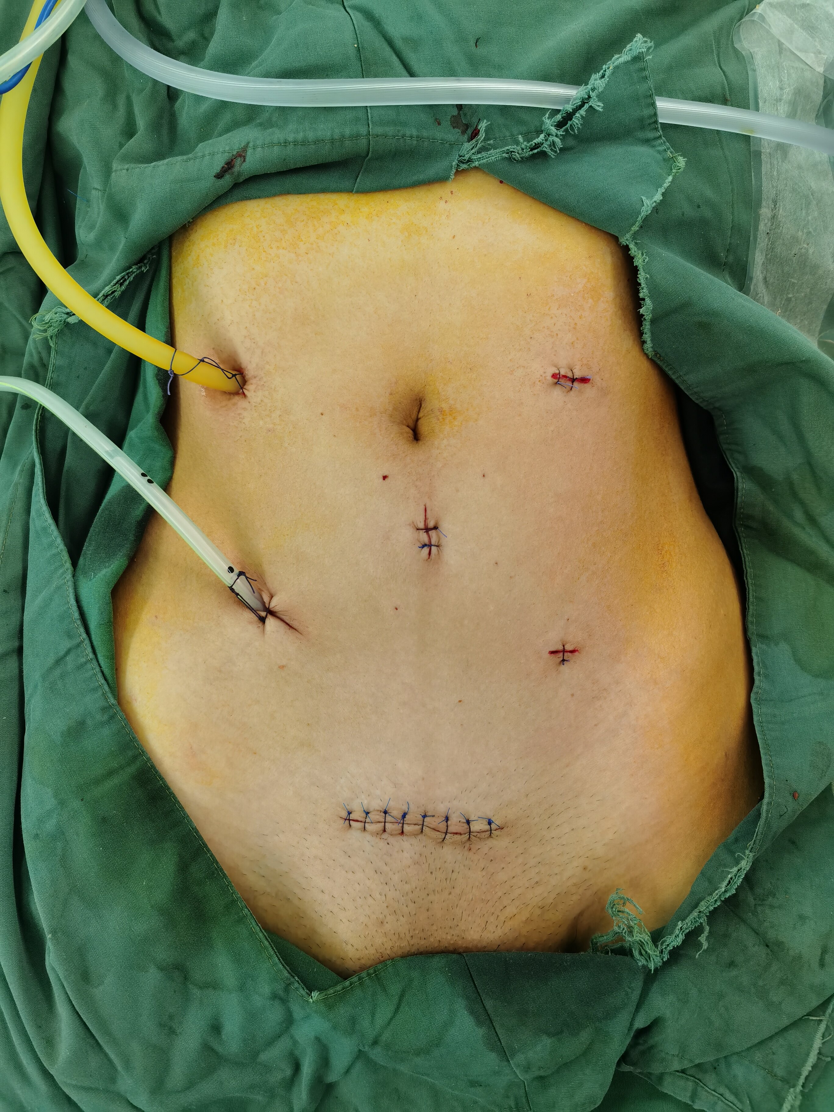 不同手术方式术后腹壁切口对比noses手术患者的福音