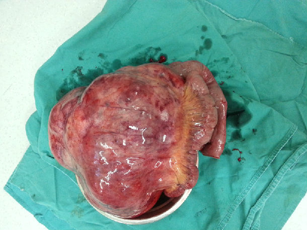 肠系膜根部的巨大肿瘤得以成功切除