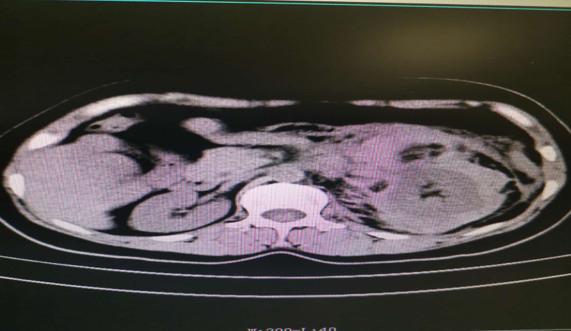 肾脏错构瘤破裂出血介入治疗