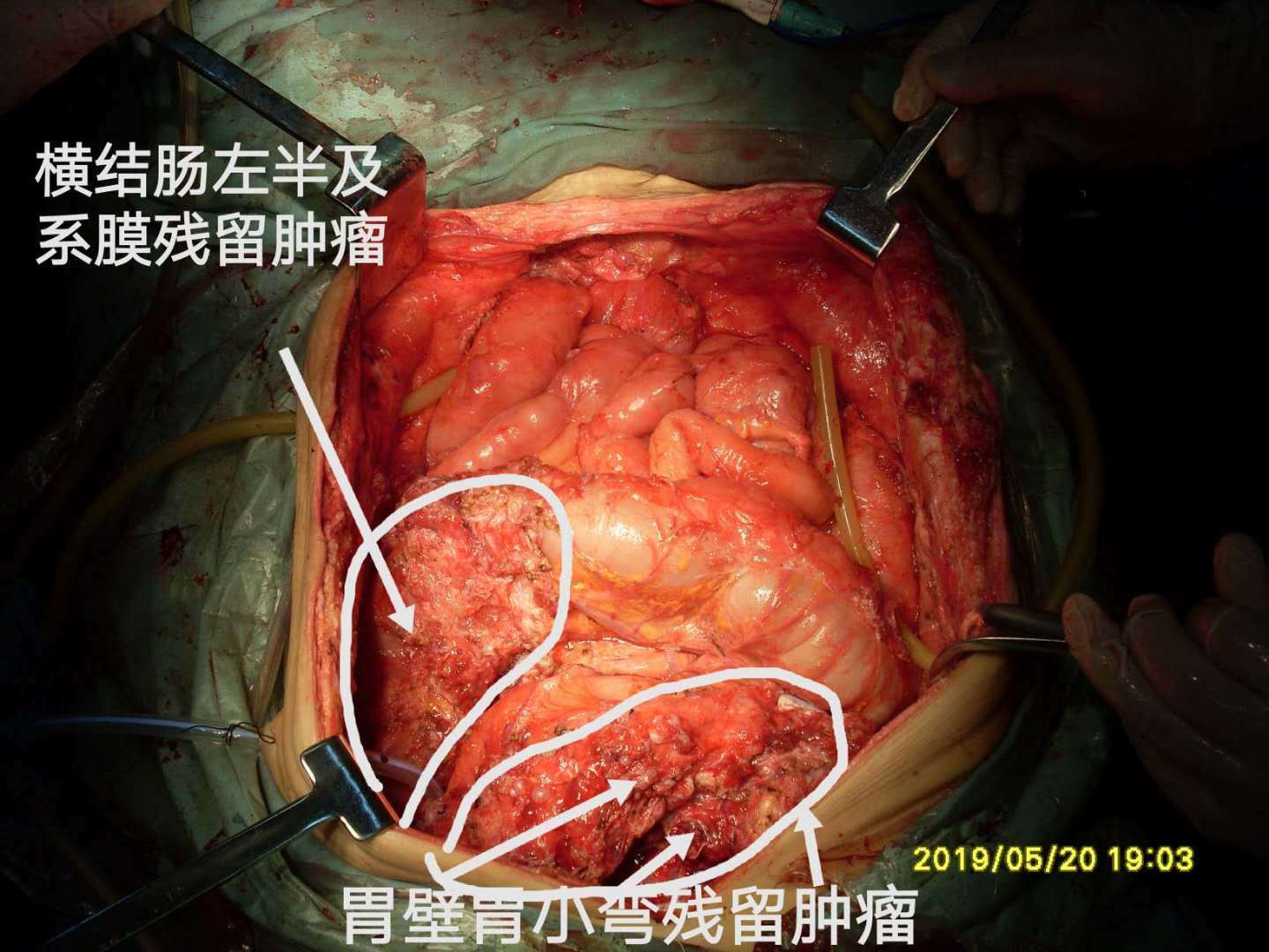 病例66--小阑尾大卵巢pmp晚期5次手术