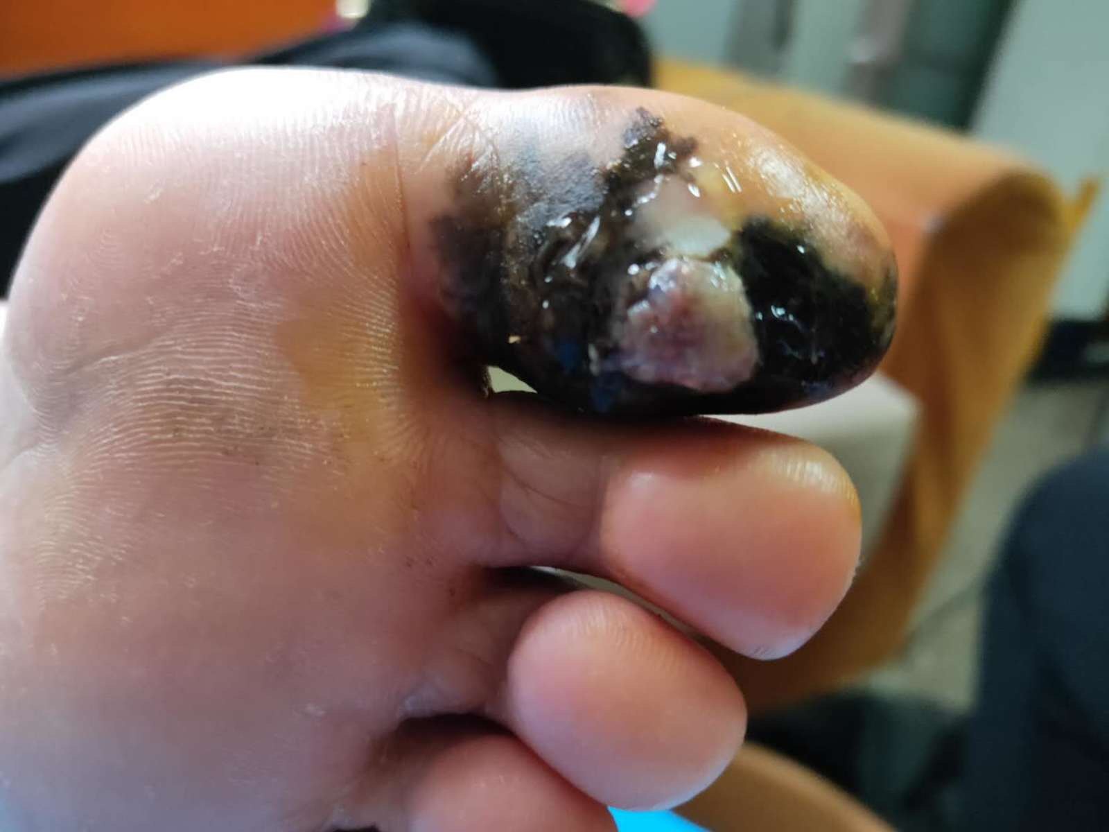 足大拇指恶性黑色素瘤
