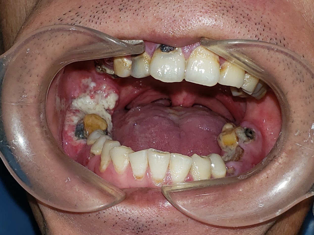 牙龈癌是什么病它有什么症状如何治疗
