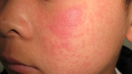 好大夫在线 杨希川 教您识别病毒疹2,皮疹特点:淡红色斑疹或丘疹,发