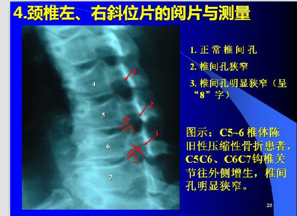 如何看颈椎病片子