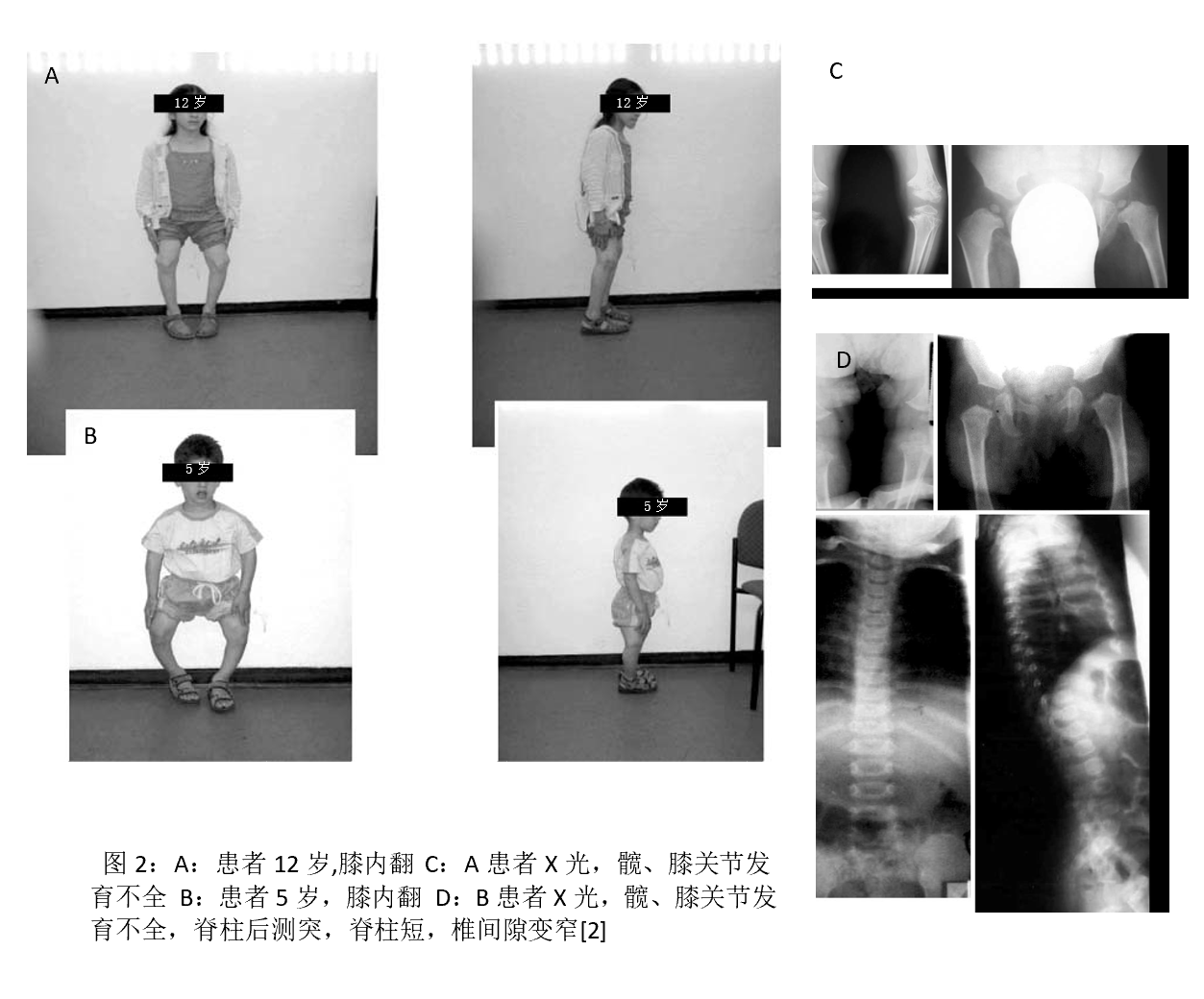 侏儒病o型腿?或许没那么简单—警惕先天性脊柱骨骺发育不全