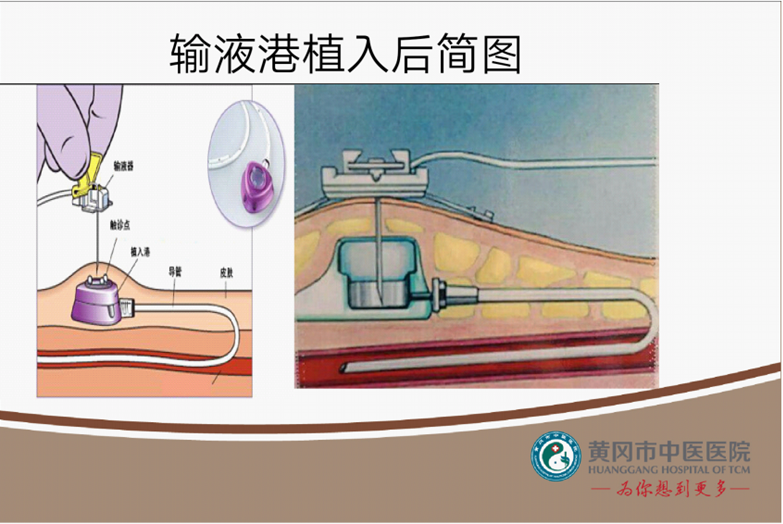 "化疗神器"输液港,到底是什么?_化疗_放化疗_日常护理_ - 好大夫在线