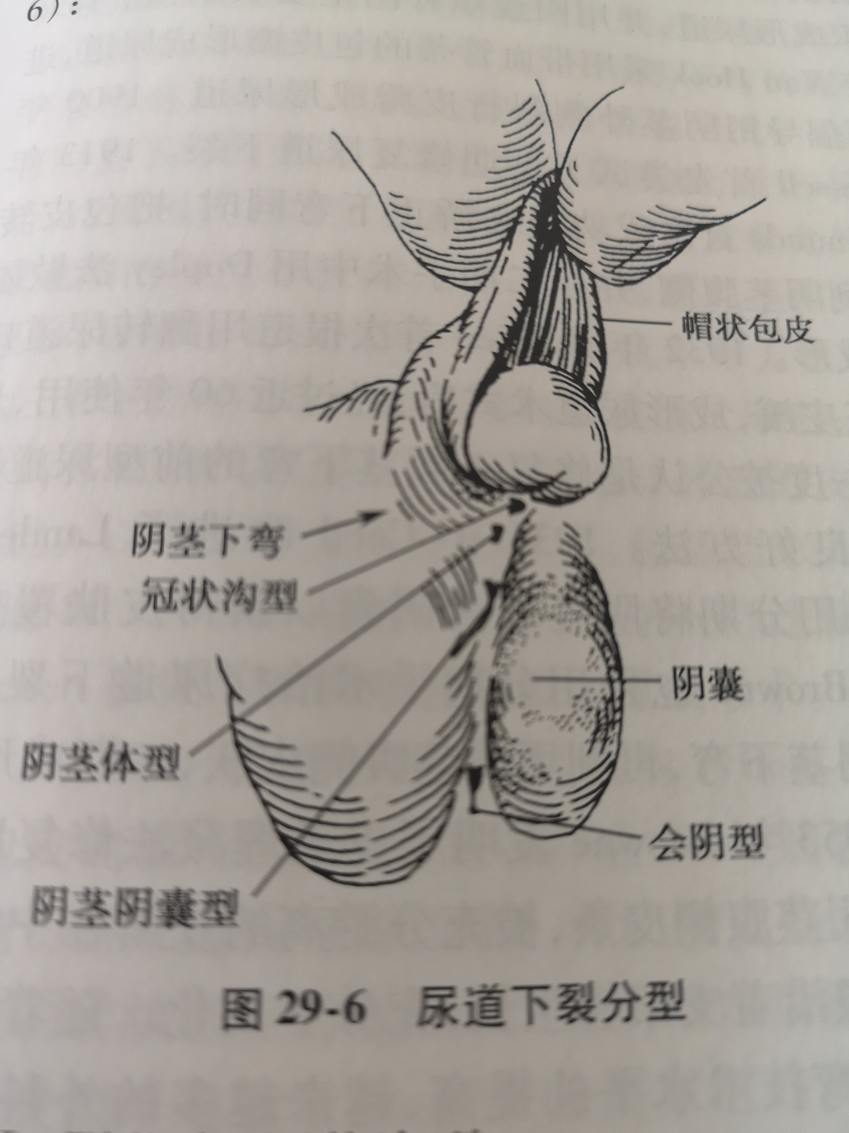 尿道口可异位于从正常尿道口近端至会阴部尿道的任何部位.