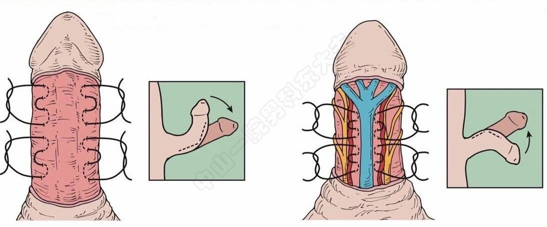 硬核知识:一般来说,弯曲后的阴茎头与阴茎体纵轴夹角小于30度的为