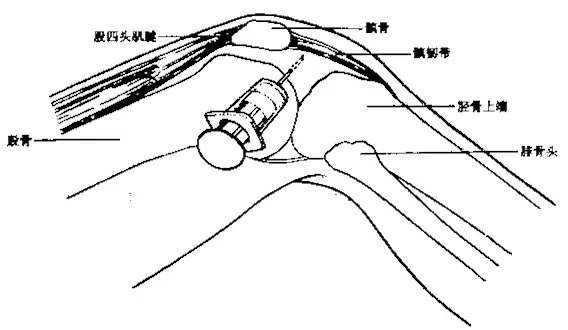 髋膝踝肩肘腕关节穿刺图文详解