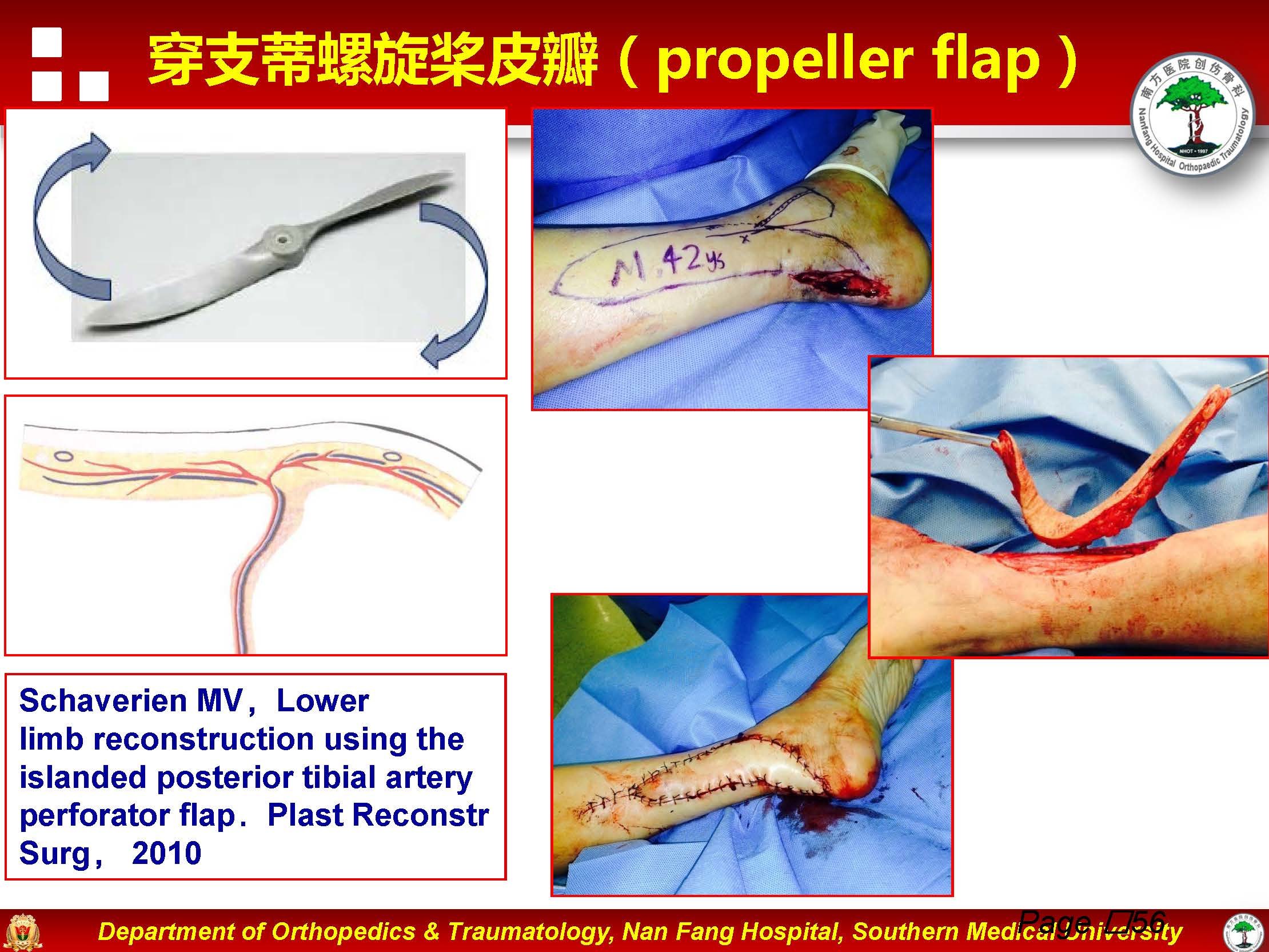 带蒂皮瓣转移修复足踝部创面(下)