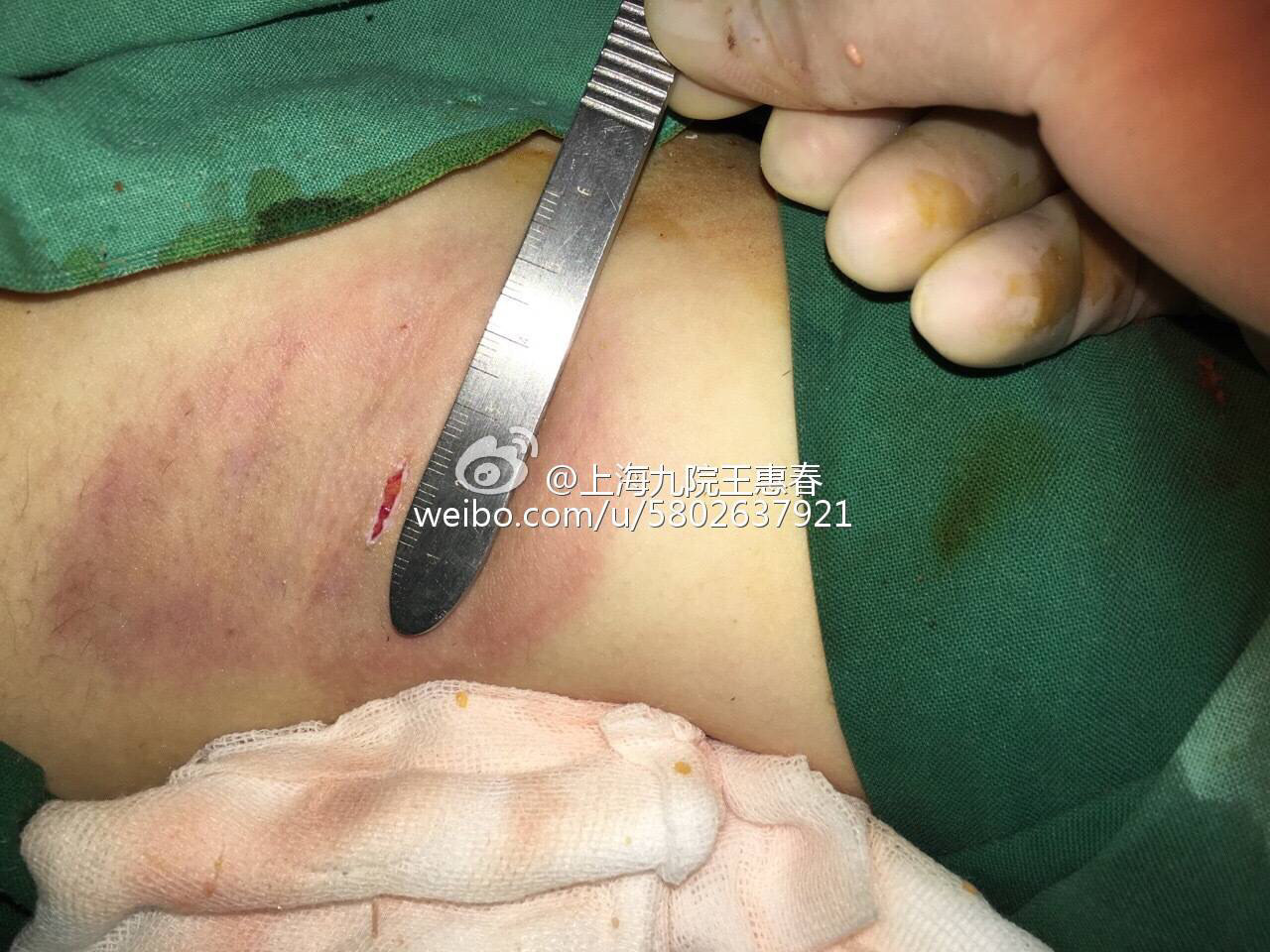 微切口(1厘米直视下腋臭根除术),图片几张.