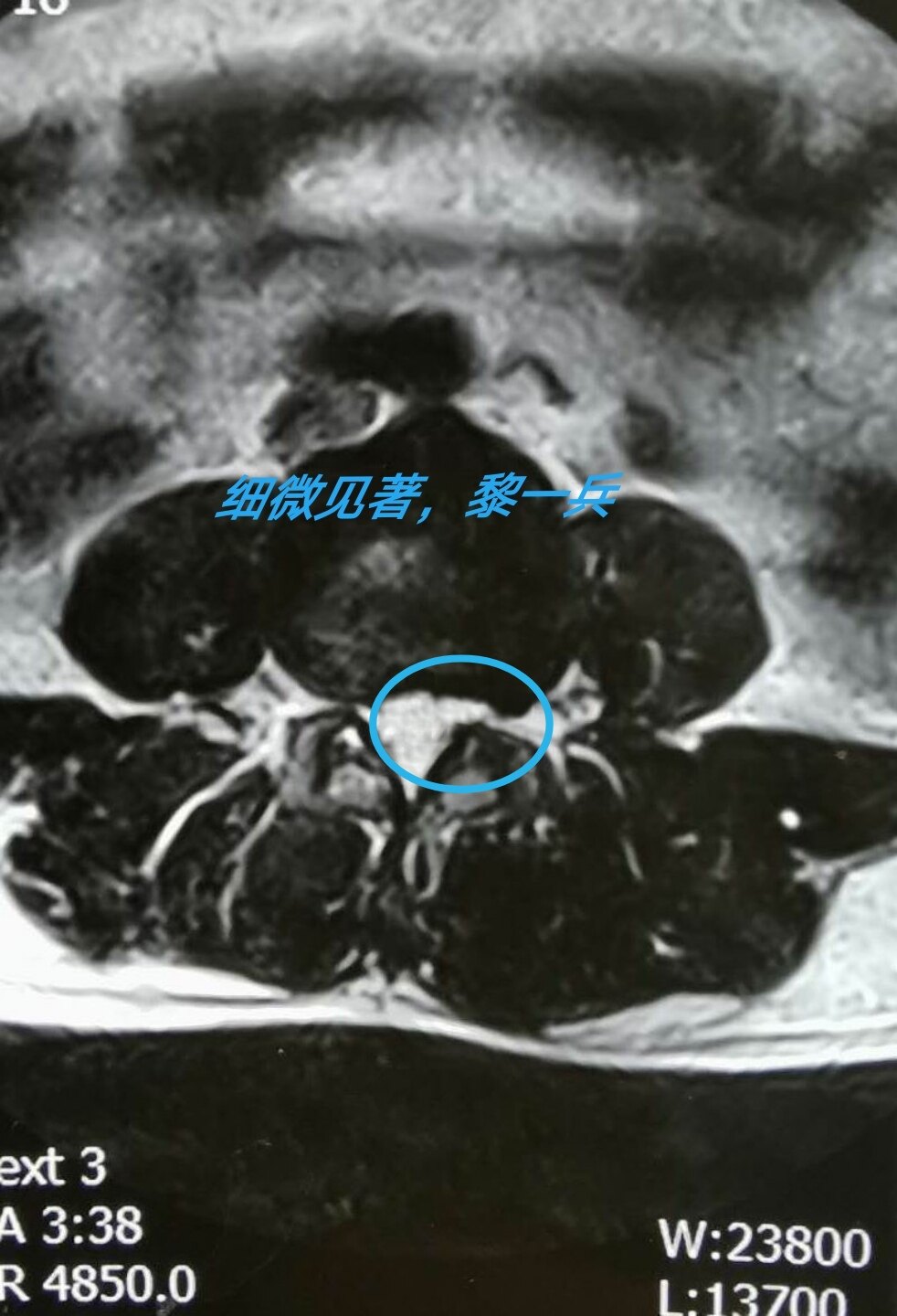 术后磁共振显示椎间盘摘除彻底,神经根管减压充分