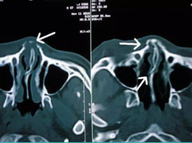 鼻骨侧位片或鼻窦ct临床诊断常需要结合外鼻淤青,畸形,鼻腔出血骨折