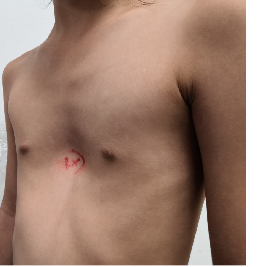 7岁女孩漏斗胸的微创手术治疗