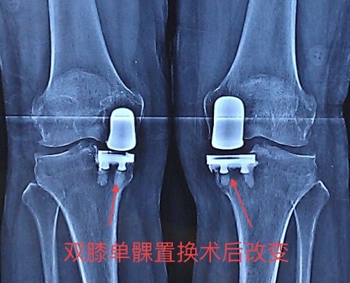 膝关节疾病之骨性关节炎