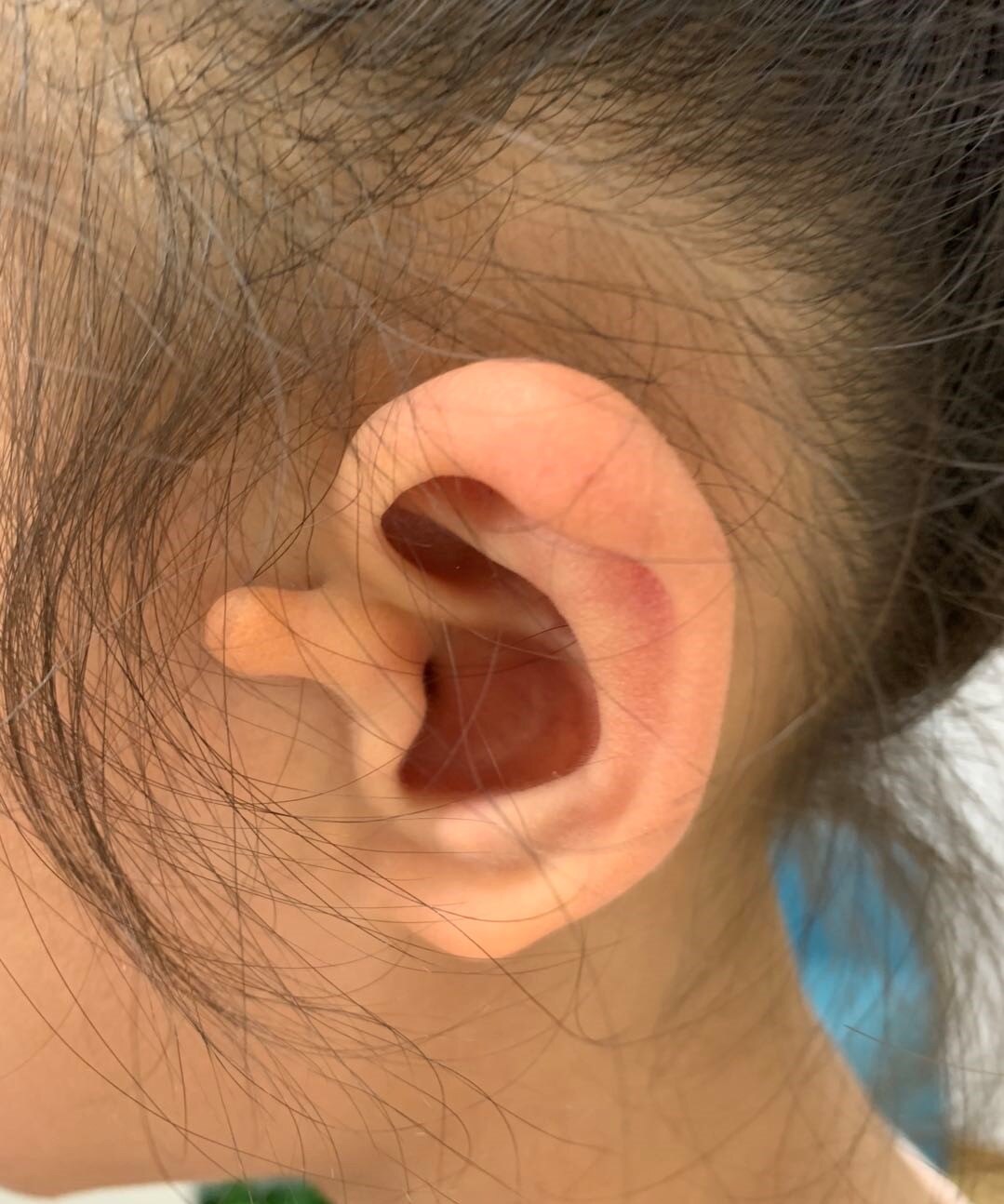常见的小问题有附耳副耳耳屏畸形的烦恼的请看过来