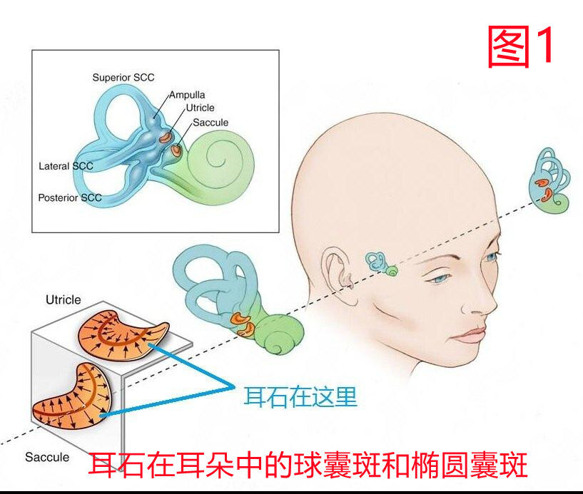 引起眩晕的耳石长什么样子