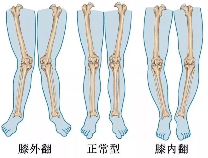 外翻膝关节,正常膝关节及内翻膝关节示意图