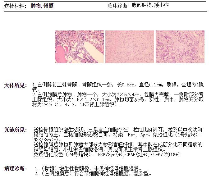 手术治疗左侧肾上腺神经节神经母细胞瘤混杂型