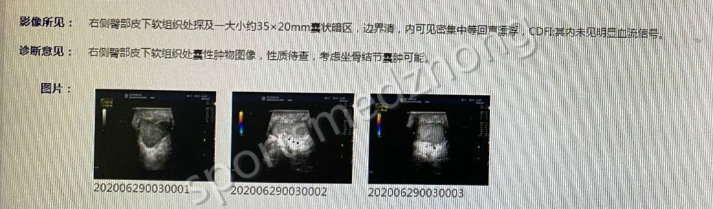 【技术动态】关节镜手术治疗坐骨结节囊肿