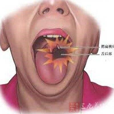 警惕舌根部疼痛舌咽神经痛
