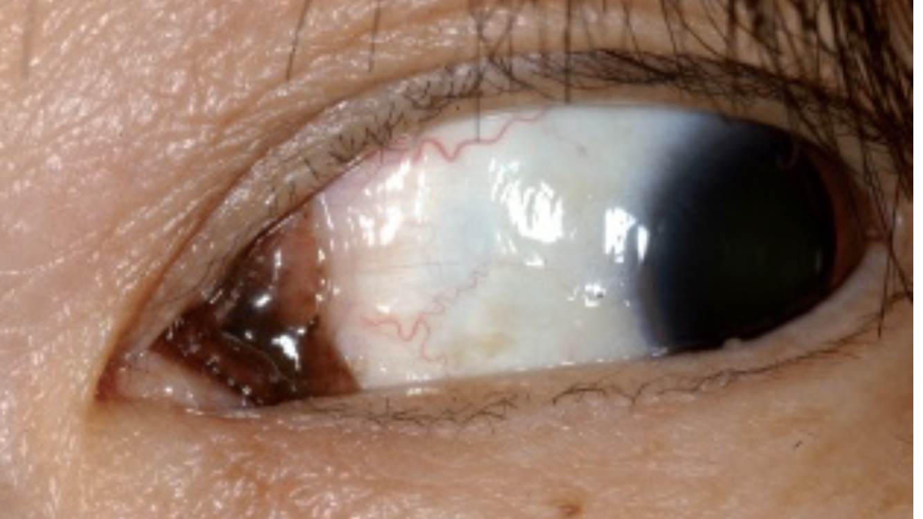 一组图带你了解结膜良恶性肿瘤_眼肿瘤 - 好大夫在线