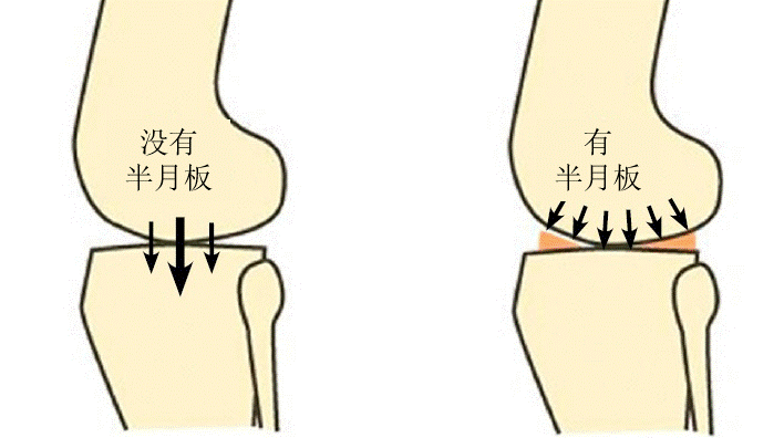 膝关节半月板损伤常见问题解读