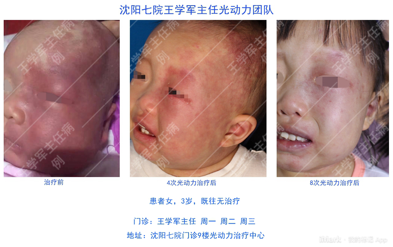 成人鲜红斑痣接受海姆泊芬光动力治疗效果如何?