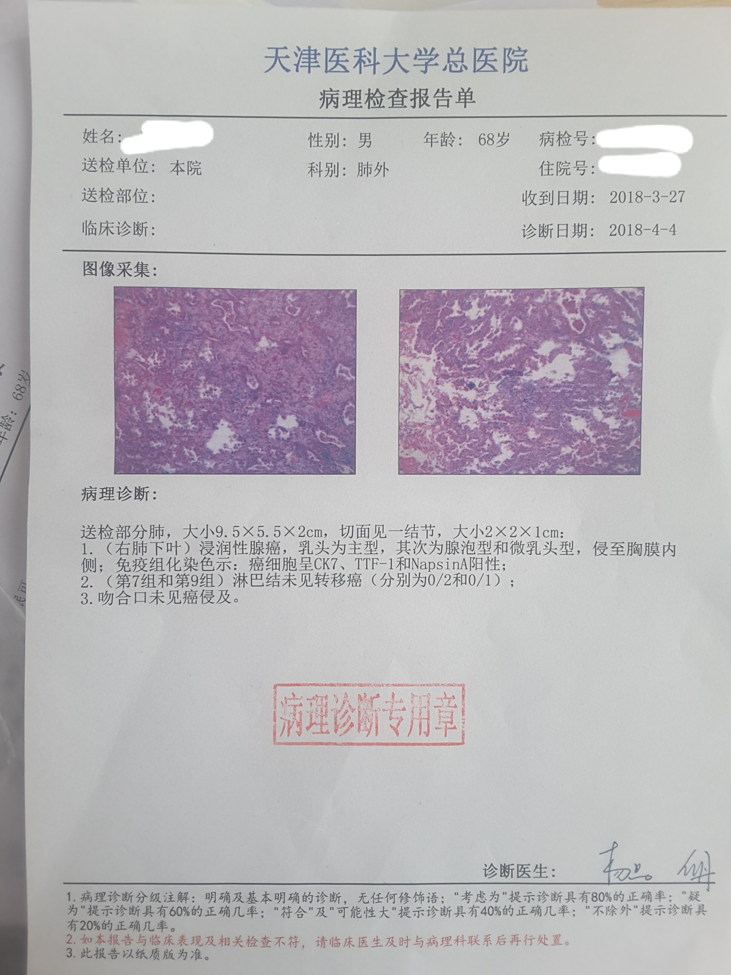 刘懿博士说肺癌二三七九发现肺结节同时有肝炎能做手术么