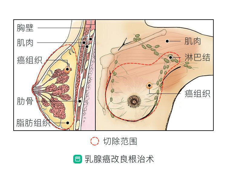 乳腺癌手术方式有哪些,如何选?