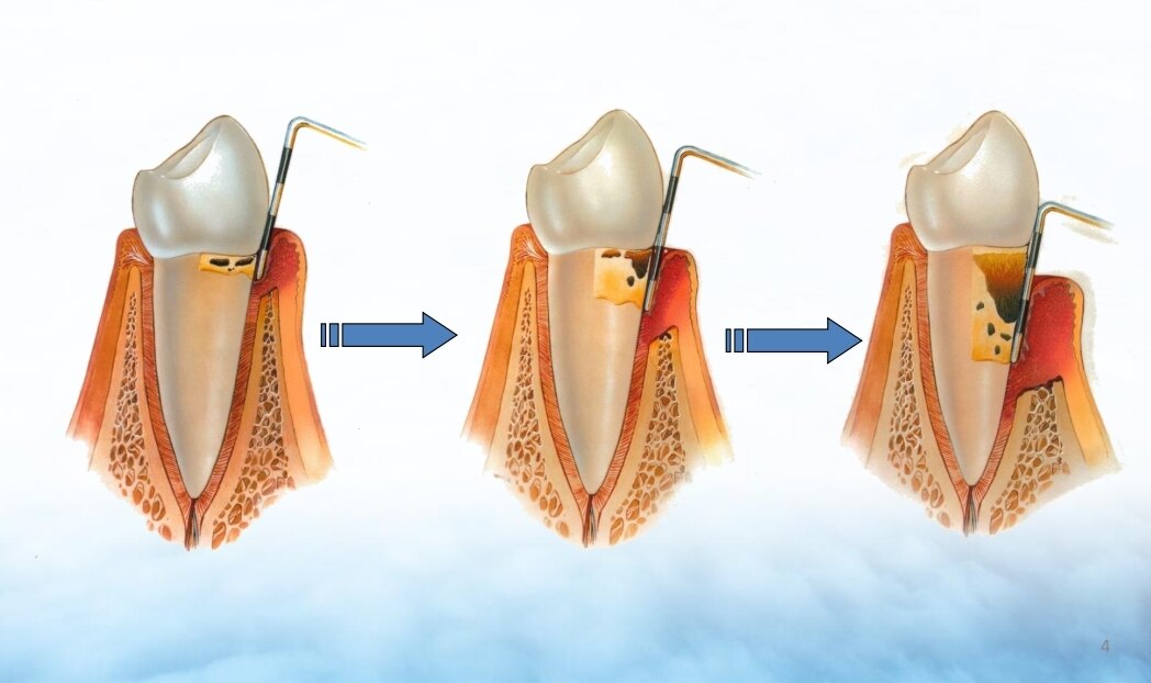 牙周袋形成由于牙龈炎症波及牙周支持组织,造成牙周支持组织和牙齿的