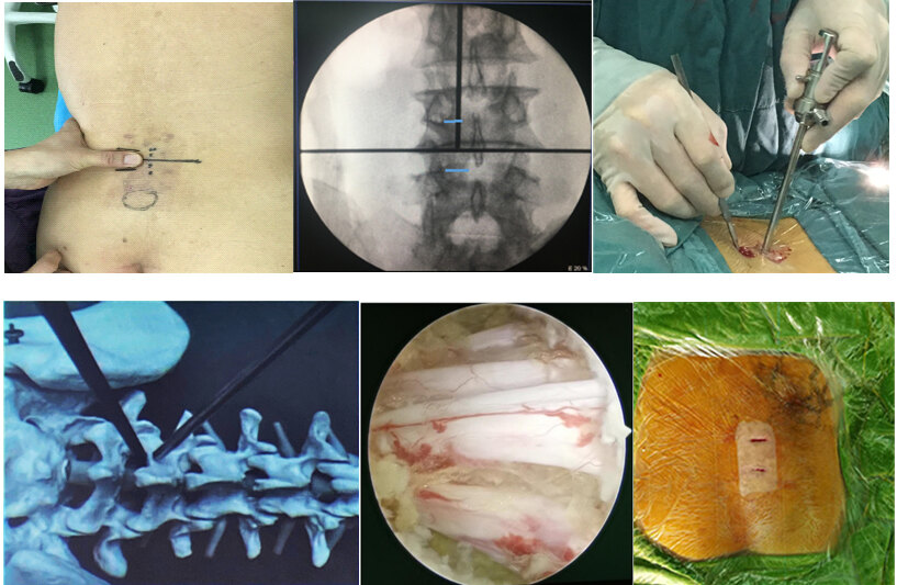 ube—脊柱内镜新技术_腰椎间盘突出 - 好大夫在线