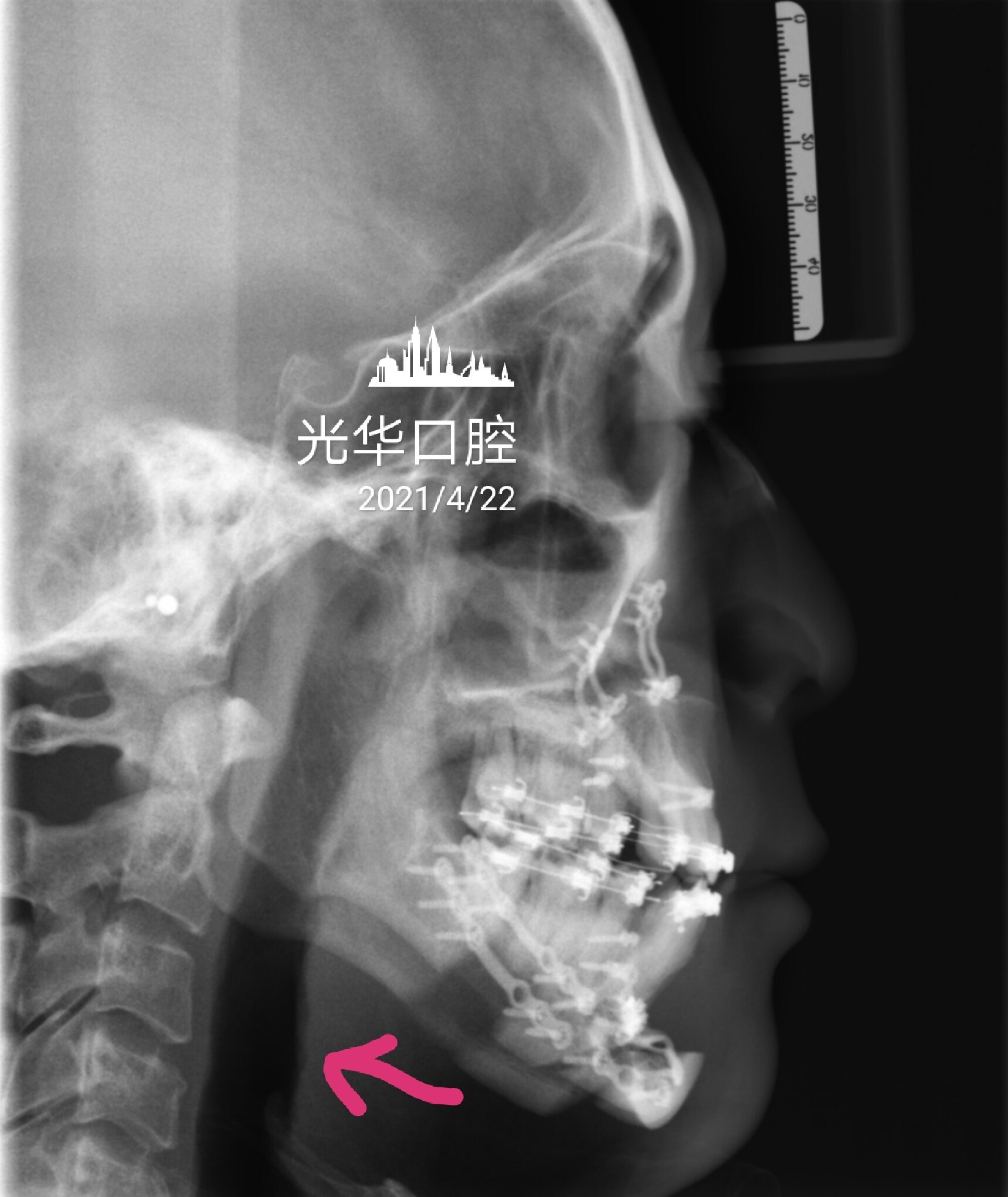 颌骨畸形也会导致睡眠窒息吗