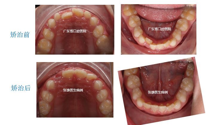 个别前牙反牙合早期矫正一例