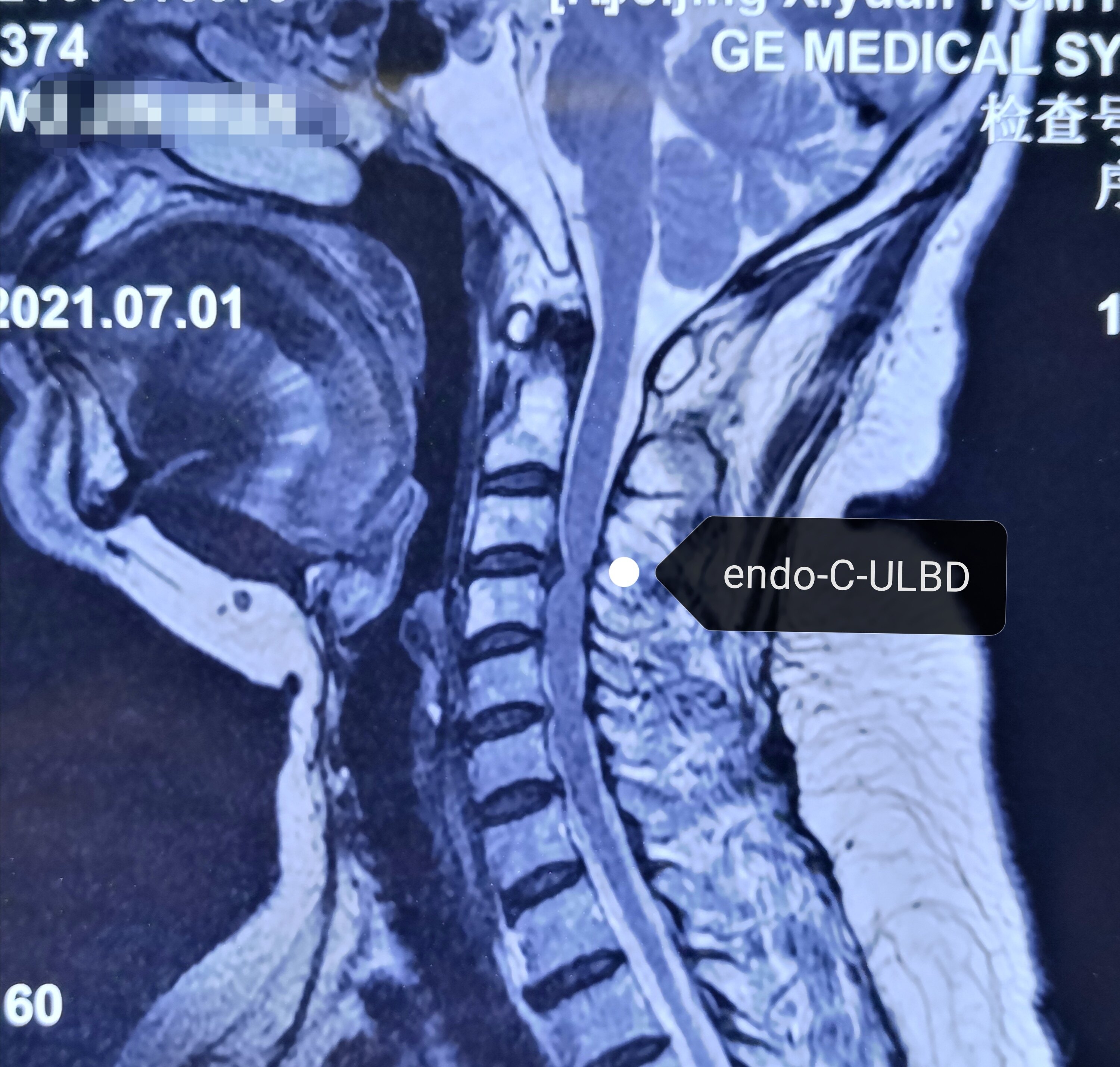 颈34节段颈椎病颈椎管狭窄症内镜下微创神经减压