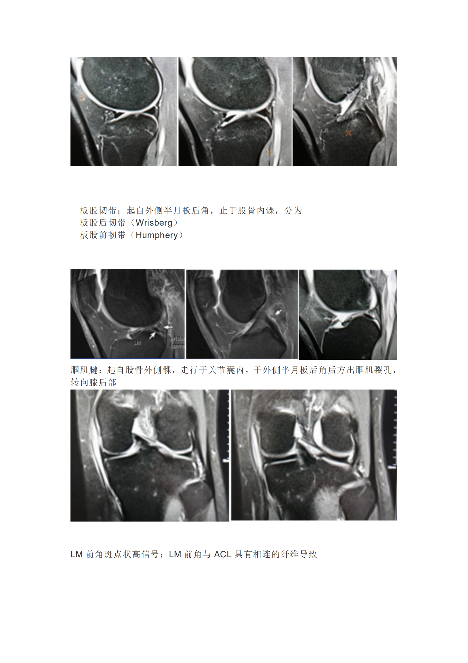 膝关节半月板病变的核磁共振检查的诊断与鉴别