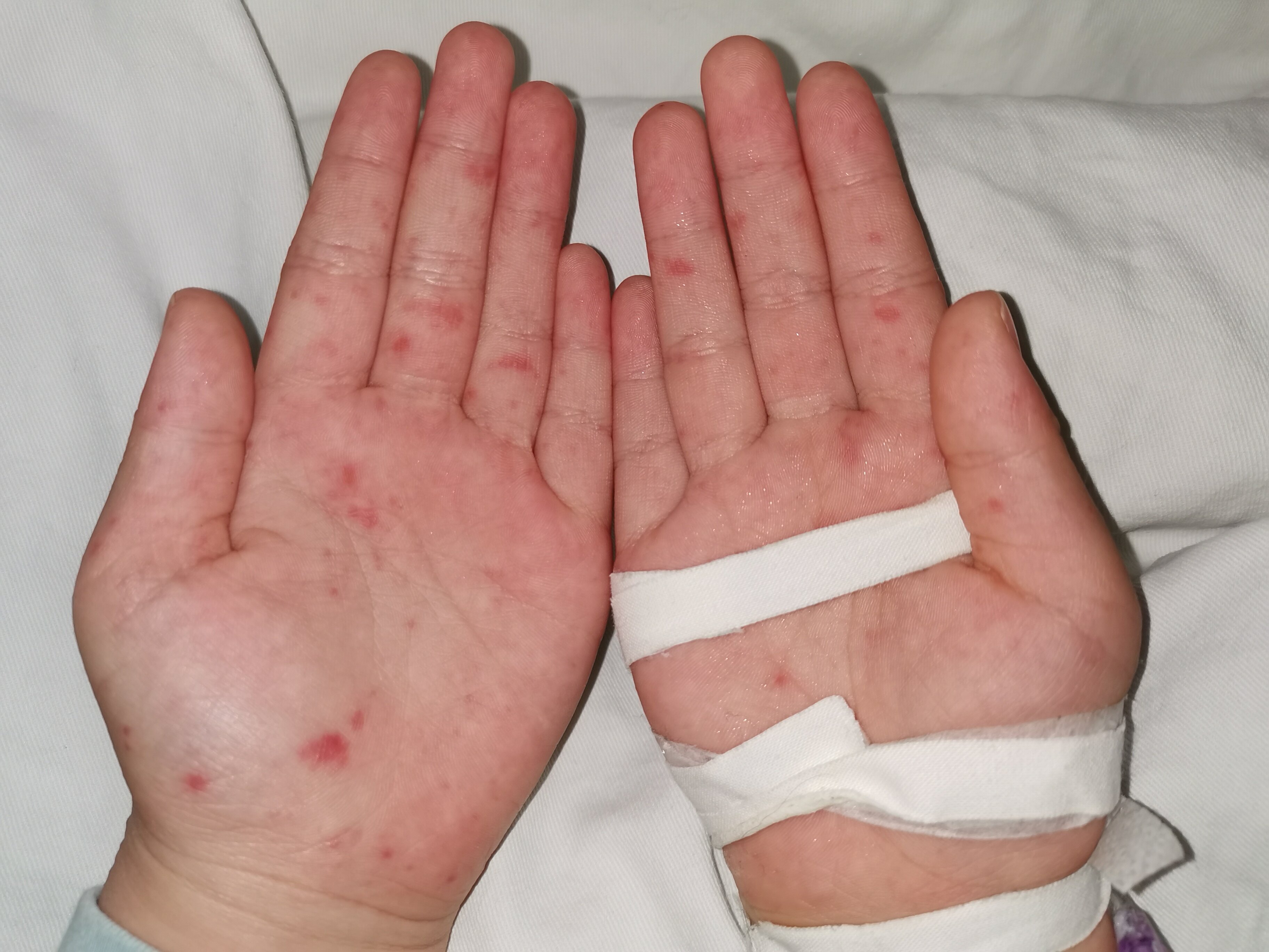 手足口典型皮疹