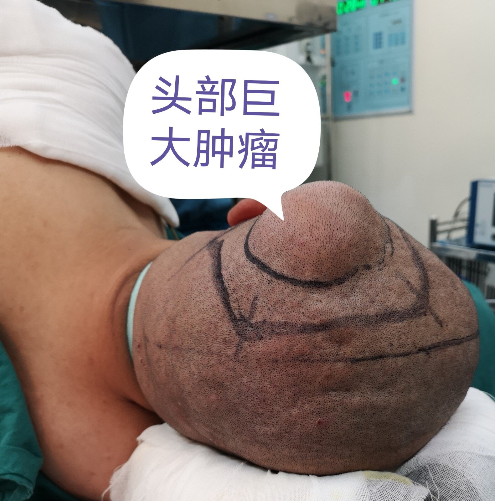 看见这么大个肿瘤,我首先考虑转移瘤可能,予以给他查了头部磁共振肿瘤