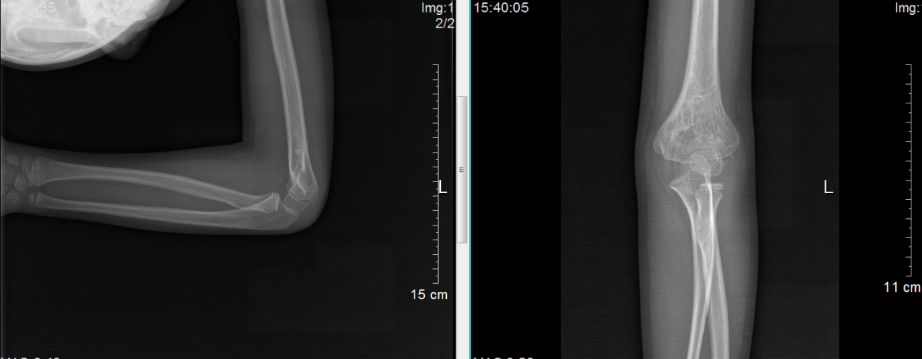 好大夫在线 潘源城 > 儿童肱骨髁上骨折 1,术后x线显示 骨折 对位对线