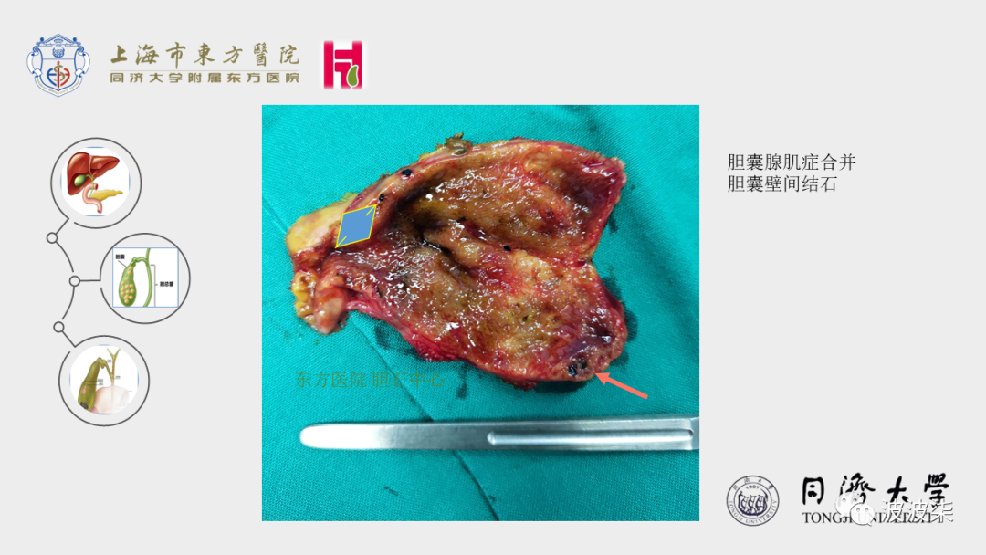 胆囊腺肌症第三讲胆囊腺肌症保胆与切胆之说