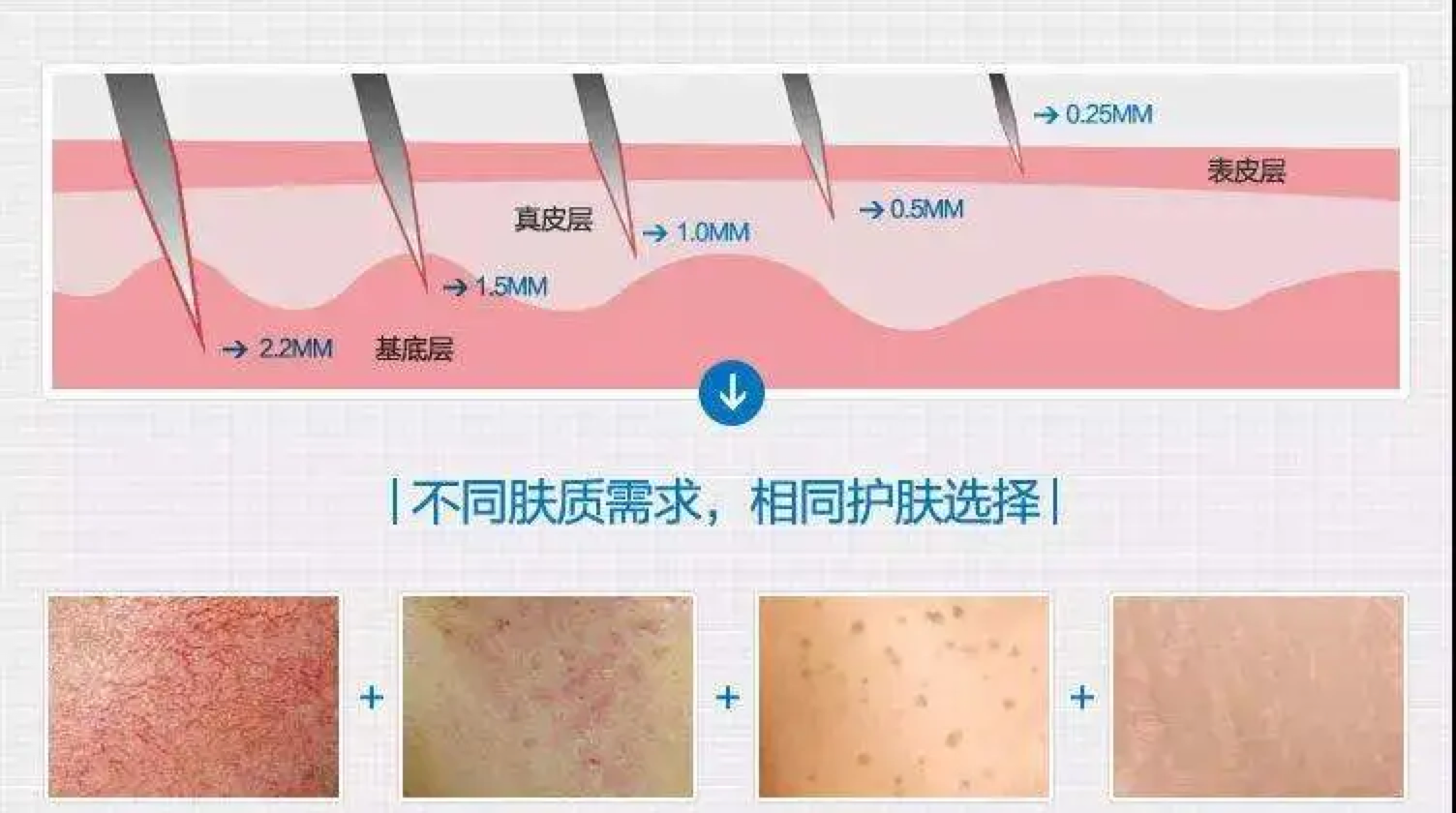 中胚层治疗水光针中胚层治疗到底是什么