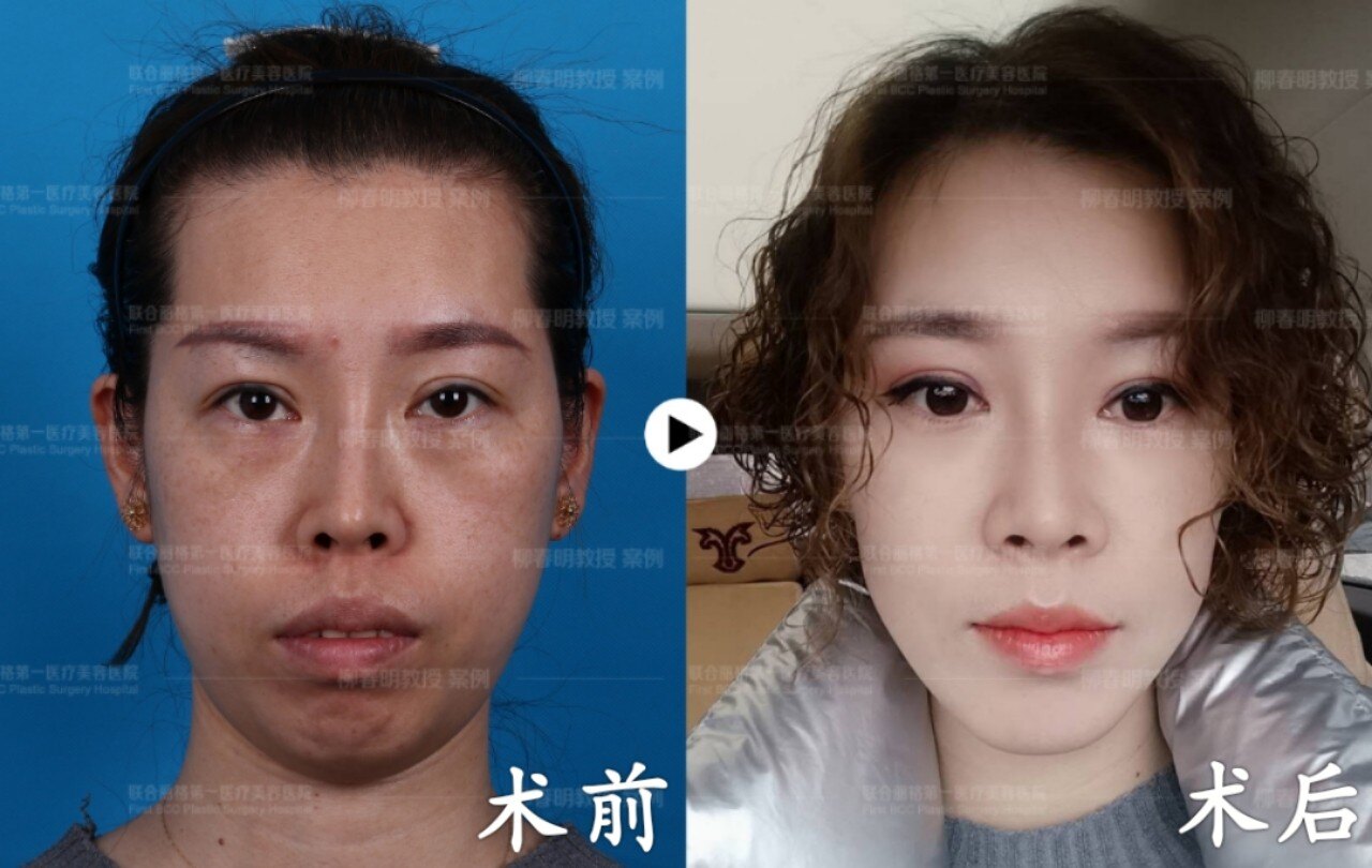 王瑞晨博士科普四级资质是正颌手术的基础条件照片为案例我院拥有肖像
