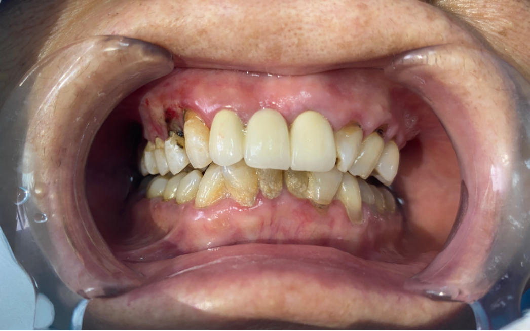 肿瘤患者牙龈尖锐湿疣激光光动力治疗一例