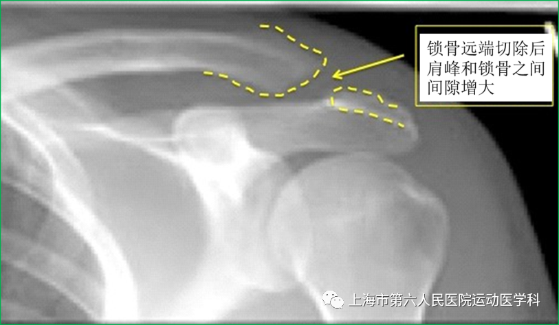 肩锁关节损伤与疼痛下