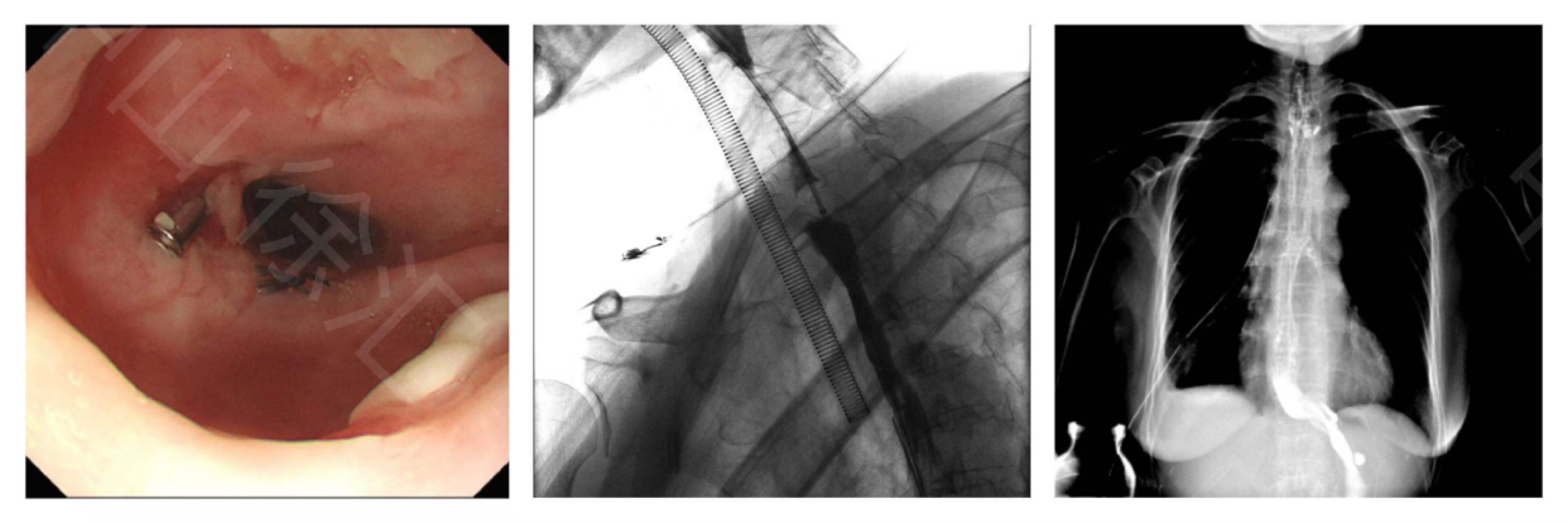 中山内镜堵瘘篇之二---食管癌术后吻合口瘘