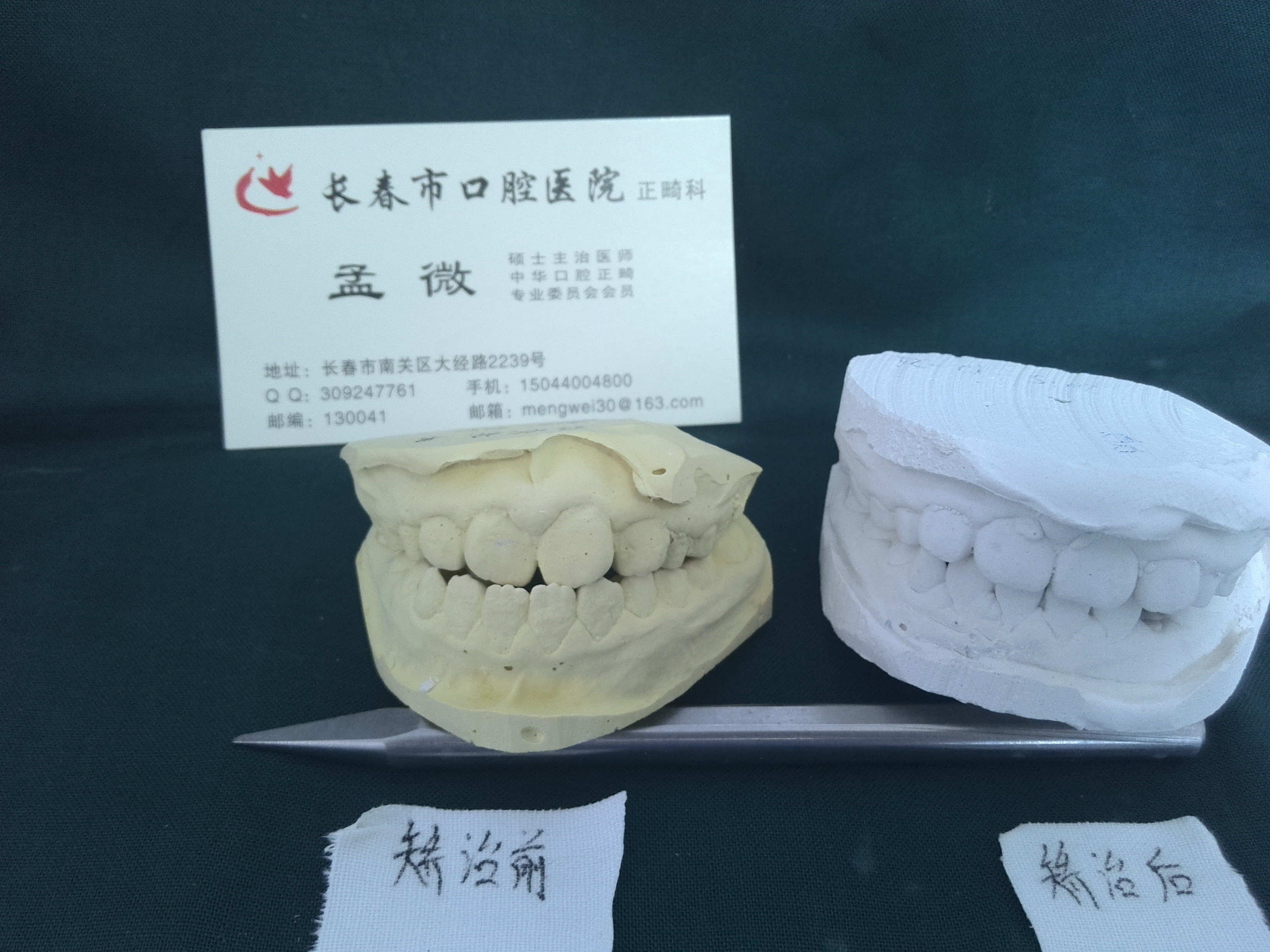 【专家“健”谈】前牙兜齿需尽早治疗_影响_牙齿_畸形