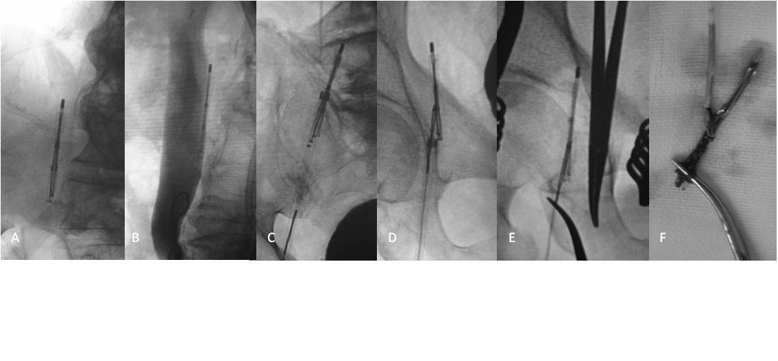 疑难性下腔静脉滤器取出的技巧及策略 - 好大夫