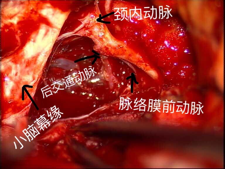 显微手术切除巨大蝶骨嵴内侧脑膜瘤窦以河青大附院